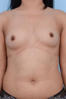 Breast Augmentation case #307
