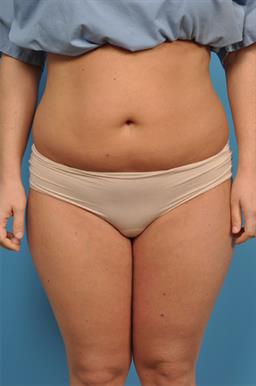 Liposuction case #33