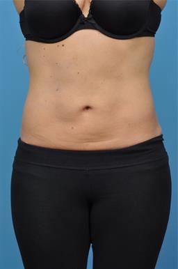Liposuction case #33