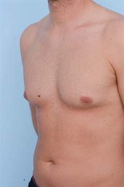 Male Breast Reduction / Gynecomastia case #334