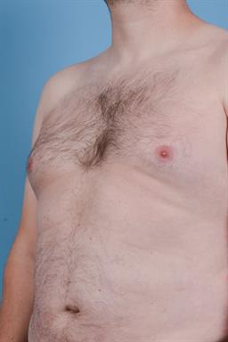Male Breast Reduction / Gynecomastia case #348