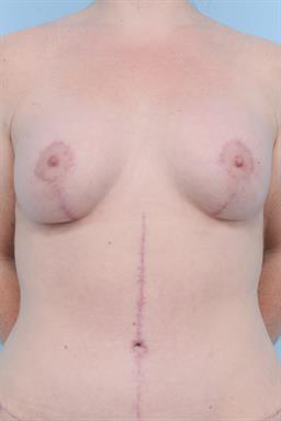Breast Augmentation case #368