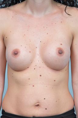 Breast Augmentation case #400