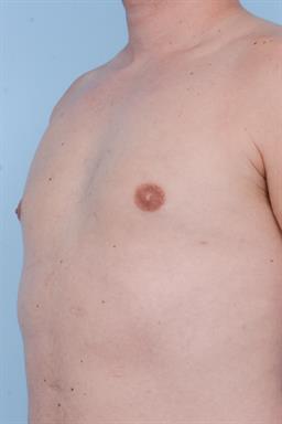 Male Breast Reduction / Gynecomastia case #417
