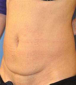 Before

52 year Old Mother of Two worried about excessive skin laxity and fat in the lower abdomen.