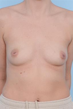 Breast Augmentation case #478