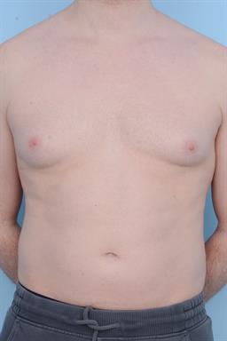 Male Breast Reduction / Gynecomastia case #515