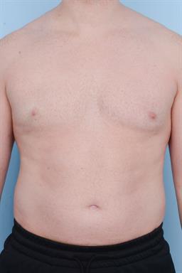 Male Breast Reduction / Gynecomastia case #515